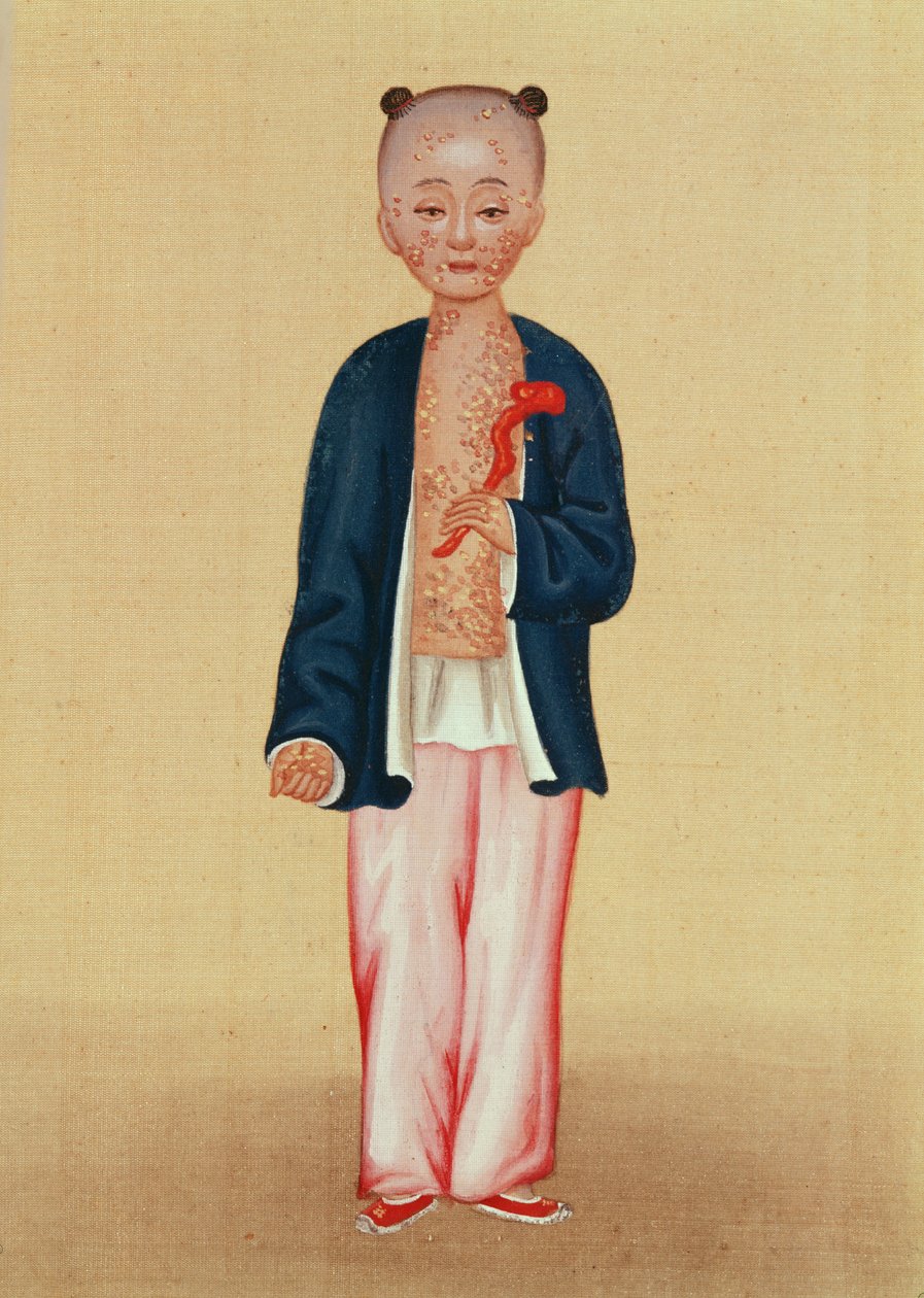 Child with smallpox by Chinese School
