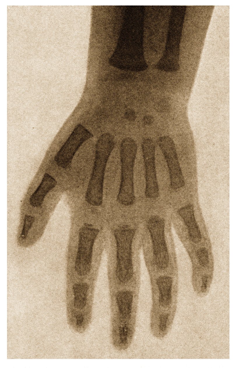 X Ray of a Child