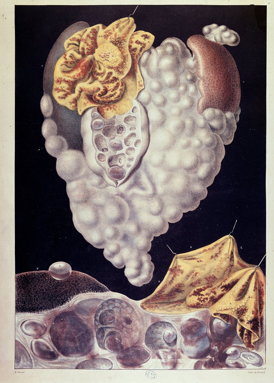 Cancer by Jean Cruveilhier