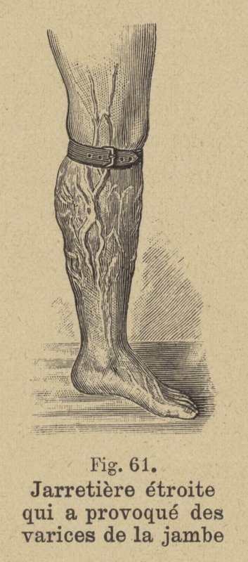 Tight garter causing varicose veins in the leg by German School